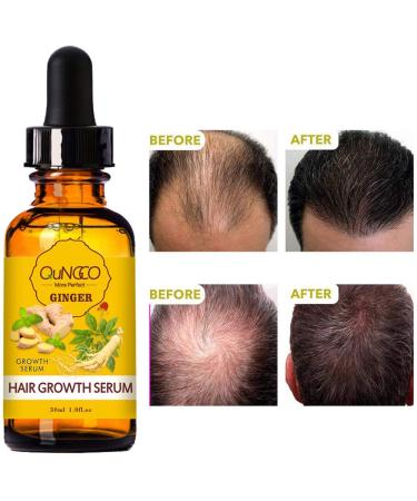 5 Pack Hair Growth Serum with Ginger Biotin for Men and Women - Prevent Hair Loss, Stimulate Regrowth, Strengthen and Lengthen Hair - Natural Formula for Thicker Strands - Buy Online on GoSupps.com