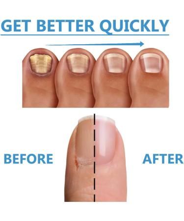 Cracked Toenail Repair Nail Nourishing Solution 30ml Nourishing Fingernail Repair Solution for Bathing Daily Travel Pedicure Manicure Overnight at Home - Buy Online on GoSupps.com