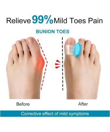 16 Pcs Gel Toe Separators - Big Toe Alignment Spacer & Bunion Corrector - Buy Online on GoSupps.com