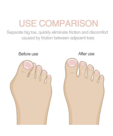 JULAR 4 PCS Gel Bunion Corrector Toe Separators for Men and Women | Breathable Fabric, Overlapping Toes Relief | Bunion Corrector with 2 Loops - Buy Online on GoSupps.com