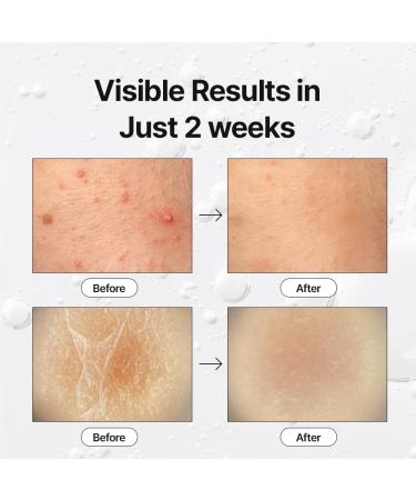 K-Beauty Exosome Reset Ampoule Gentle Exfoliating Pore-Clearing & Blemish-Calming Serum for Sensitive Skin | Daily Clarifying Step (30ml) - Buy Online on GoSupps.com