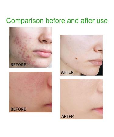 Acne-Fighting Facial Cleanser - Deep Cleanse Remove Oil Dirt Blackheads & Pimples Shrink Pores Refreshing & Comforting(2PCS) 1 Count (Pack of 1) - Buy Online on GoSupps.com