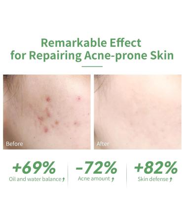 Buy 10% Salicylic Acid Serum - Acne Treatment Minimize Pores & Redness Relief for Sensitive Skin - 30ml - Buy Online on GoSupps.com