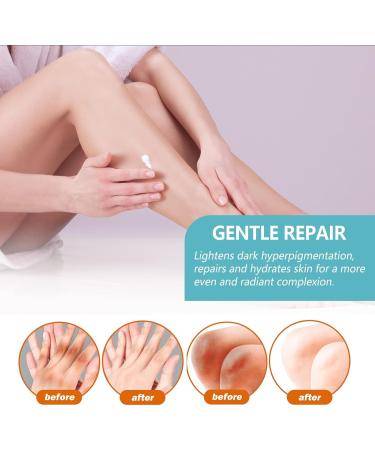 Dark Knuckles Whitening Serum 50g Acanthosis Nigricans Therapy Cream Dark Spot Corrector Cream Dark Spot Remover for Underarms Knees Elbows Inner Thigh - Buy Online on GoSupps.com