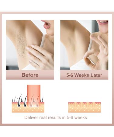 FDA Cleared High Energy IPL Hair Removal for Women and Men - Ice Cooling Protection, 999,999 Flashes - Reduce Pain, Laser Hair Removal for Whole Body - Sleek White - Buy Online on GoSupps.com