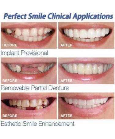 Xiaocui Provisional Dentures - Comfort Fit Temporary Smile Cosmetic Teeth Prosthesis & Easy to Clean Veneers for All - Buy Online on GoSupps.com