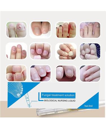 Okita Toenail Fungus Treatment Pen - Effective Nail Repair for Healthy and Strong Nails (5Pcs) - Buy Online on GoSupps.com
