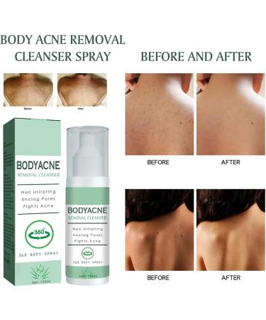Back Acne Treatment Spray - Buy Online on GoSupps.com