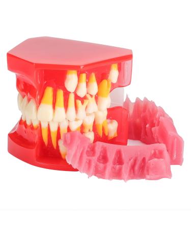 Teeth Eruption Development Model - Alternating Model of Constant Pressure of Deciduous Teeth Clearly to Show The Process of Change to Permanent Dentition