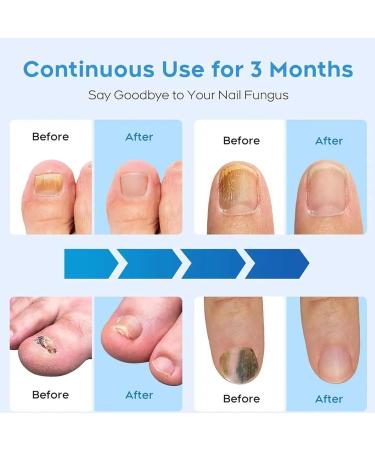 Onycare Solution contre la mycose laser mycose ongle pied - Buy Online on GoSupps.com