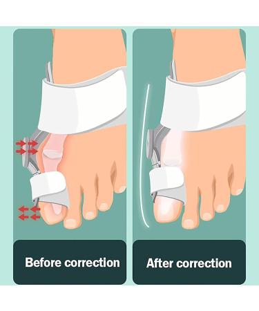 Oiakus Bunion Orthotics with Precise Adjustment Scale - Big Toe Straightener and Corrector for Hallux Valgus - Buy Online on GoSupps.com