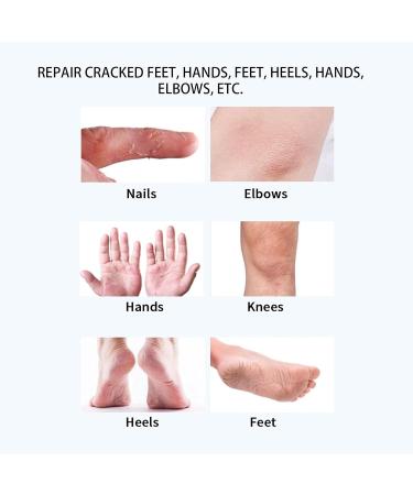 Horn Skin Remover Foot Cream | 50ml Urea 2% & Salicylic Acid | Intensive Moisture for Dry Cracked Skin - Buy Online on GoSupps.com