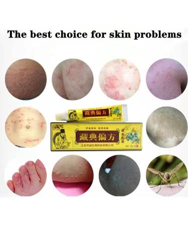 Chinese Herbal Eczema Psoriasis Cream | Anti-Itch Dermatitis Relief | Defeon New Face & Body Cream - 1pcs - Buy Online on GoSupps.com