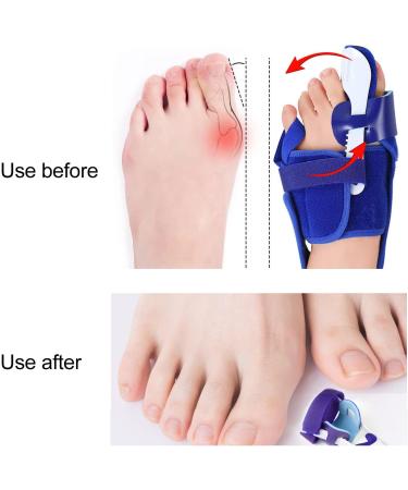 Bunion Corrector Toe Separators - Soft Fabric, Adjustable Strength, Prevents Deviation - Left Foot - Buy Online on GoSupps.com