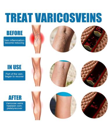 3 Piece Varicose Vein Treatment Spray Set | Soothing Vein Healing Spray for Legs | Effective Relief for Varicose Veins - Buy Online on GoSupps.com