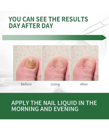 Extra Strength Toenail Fungus Treatment - 30ml | Effective Nail Fungus Solution for Thick Broken & Discolored Nails - Fast Shipping Internationally - Buy Online on GoSupps.com
