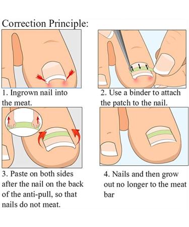 Toenail Tool 6 in 1 Ingrown Toe Nail Fixer Pedicure Toenail Recover Nail Foot Care Kit Ingrown Toenail Corrector for Men Women(24pcs) - Buy Online on GoSupps.com