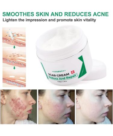 Aliver Scar Removal Cream - Stretch Mark & Acne Remover for Men & Women - Effective Treatment for Old & New Scars, Cuts, and Keloids - Buy Online on GoSupps.com