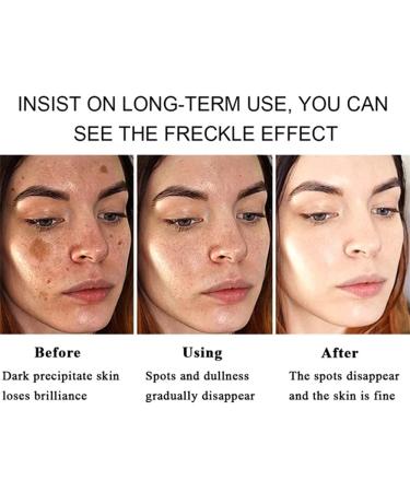 Axnoocy Dark Spot Remover Cream - Instant Results for Blemish, Melasma, Freckle, Sun Spot Removal - 0.71fl.oz - Suitable for All Skin Types - Buy Online on GoSupps.com