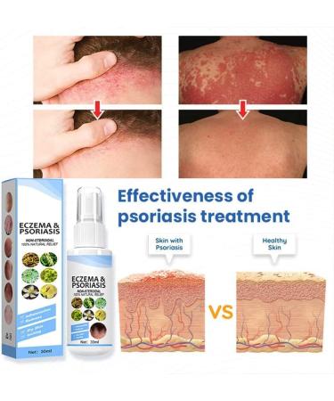 XWFJ Meellop Herbal Psoriasis Relief Spray - Soothes Eczema & Vitiligo, Repairs Skin - Face & Body - 1pc - Buy Online on GoSupps.com