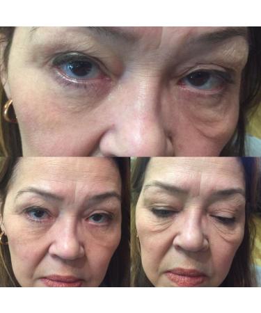 Dynamic Innovation 60 Second Instant Eye Lift - Fast and Effective Results - Buy Online on GoSupps.com