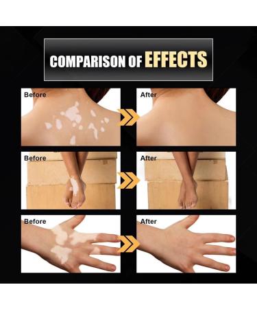 Vitiligo Removal Relief Spray - Reduces White Spots on Skin - 3pcs - Buy Online on GoSupps.com