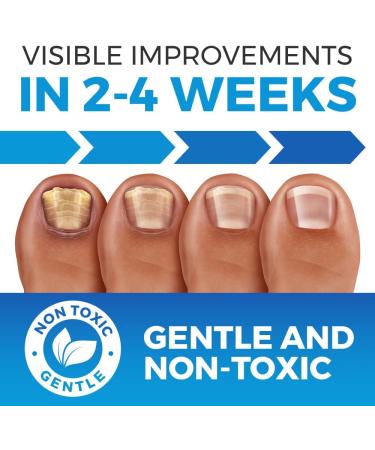 Ultimate Nail Fungus Treatment Set - Fungal nail treatment with Preventive Anti-fungal Shoe and sock Spray and pink Nail Polish - Buy Online on GoSupps.com