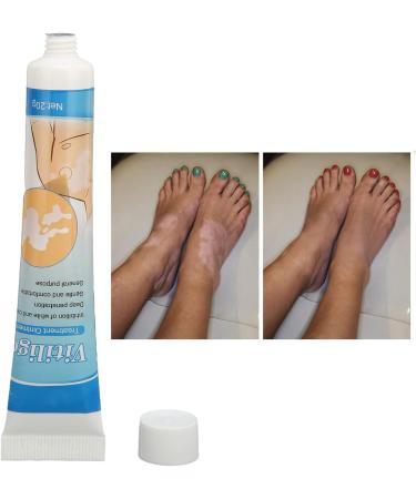 Vitiligo Cream 30G - Herbal Extract Treatment for White Spots & Skin Pigmentation - Creme Medix Leukoplakia Solution - 0.7oz - Buy Online on GoSupps.com