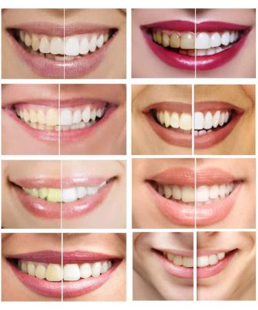iSmile Teeth Whitening Kit with Dual Lighting Technology - 35% Carbamide Peroxide & Desensitizing Gel - Buy Online on GoSupps.com