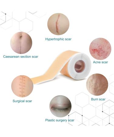 Meinuo Silicone Scar Sheets - Roll Scar Tape for Safe & Painless Scar Removal - 1.6 x 120 - Ideal for Body, Burn, C-Section, Keloid, Acne, Surgery - Buy Online on GoSupps.com