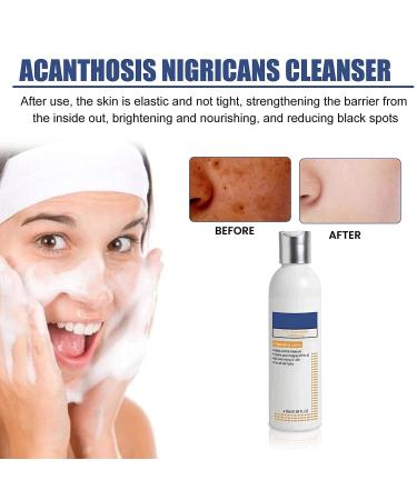 BIERELAOZI Skinenjoy Cleansing Lotion for Acne & Spots - Acanthosis Nigricans Therapy Cream | Dark Spot Remover for Face & Body (1 PC) - Buy Online on GoSupps.com