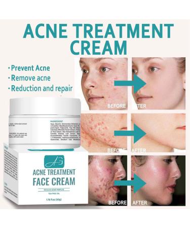 Acne B-Gone Moisturizer Cream - Tea Tree Oil Nighttime Treatment for All Skin Types Fights Pimples Overnight - Buy Online on GoSupps.com