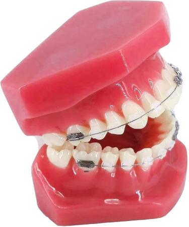 Ceebus Orthodontic Model with Metal & Ceramic Brackets - Ideal Oral Demonstration Tool for Dentists | International Shipping Available - Buy Online on GoSupps.com