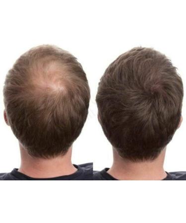 100% Natural Keratin Hair Building Fibres - Refill for Hair Loss - Alopecia & Chemotherapy (50g Dark Brown) - 50g (Pack of 1 - Buy Online on GoSupps.com