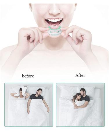 Lmeili Tooth Rail Anti-Snoring Device | Professional Dental Guard | Oral Appliance for Teeth Grinding | Upper & Lower Jaw Support - Buy Online on GoSupps.com