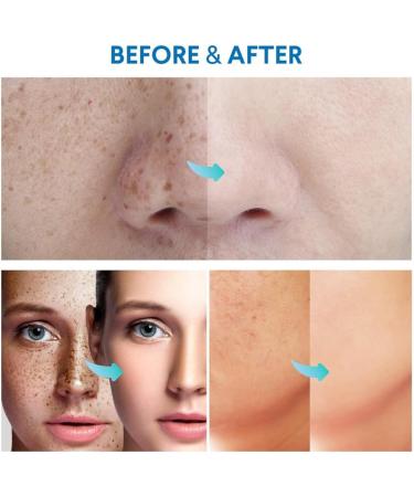 Razor Bumps Treatment for Women and Men Ingrown Hair Treatment After Shave Repair for Bikini Area Face Neck Legs and Underarm Area After Shave for Women and Men Ingrown Hair Serum - Buy Online on GoSupps.com