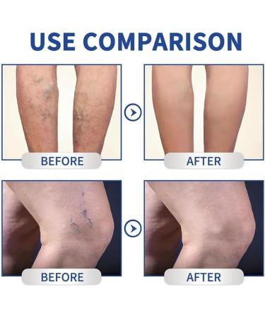 EXQST Mucopolysaccharide cream with polysulfuric acid Cream Varicose Veins Repair Cream for Legs Earthworm Varicose Veins - Buy Online on GoSupps.com