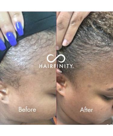 Hairfinity Infinite Edges Hair Serum - Hair Growth Treatment for Alopecia - Stimulates Hair Follicles, Prevents Hair Loss, and Promotes Regrowth - Sulfate & Silicone Free - Buy Online on GoSupps.com