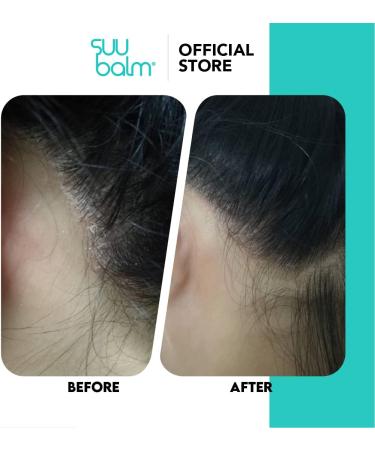 Suu Balm Scalp Spray 100ml - Rapid Itch Relief Moisturizer for Dry, Flaky, Itchy Scalp - 5 Min Itch Relief Treatment - Buy Online on GoSupps.com