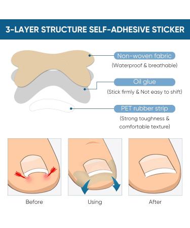 Ingrown Toenail Treatment - 100Pcs Breathable Corrector Patches & Strips | Pain-Free Nail Correction Durable Light Brown Stickers for Effective Ingrown Nail Care - Buy Online on GoSupps.com