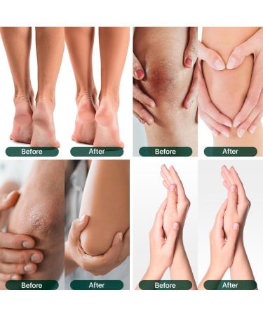 40% Urea Cream for Feet - Ultra Moisturizing Repair Treatment for Dry Cracked Heels & Calluses with 2% Salicylic Acid - Softens & Exfoliates Hands Knees Elbows - Buy Online on GoSupps.com