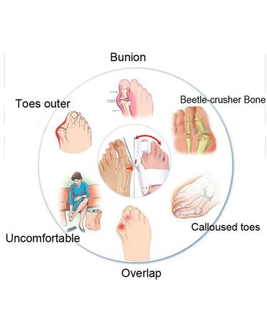 Adjustable Bunion Splint Corrector - Toe Straightener for Pain Relief | Orthopedic Brace for Hallux Valgus | Unisex Hammer Toe Support - Buy Online on GoSupps.com