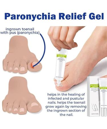 DUBUSH 2023 Removal Paronychia Gel Nail Nail Treatment Repair Gel Instant Beauty Gel for Nail Growth Care Anti Paronychia Relief Cream Toe and Fingernail Repair 5 pieces - Buy Online on GoSupps.com