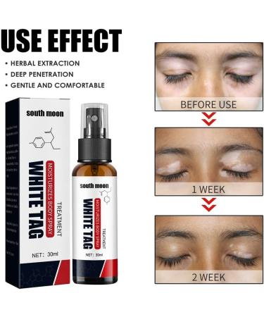Kolmax Alkyne Psoriasis and Vitiligo Relief Spray - Reduces White Spots on Skin - 3PCS - Buy Online on GoSupps.com
