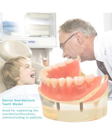 Dental Model Overdenture with 4 Implants - Ideal for Teaching Toothbrushing & Hygiene in Classes - International Shipping Available - Buy Online on GoSupps.com