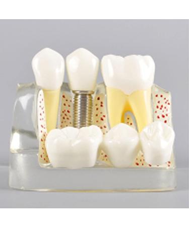 Dental Model Dentist Dental implant Model Resin Material Removable Used for Dental Clinic Research and Doctor-Patient Communication - Buy Online on GoSupps.com