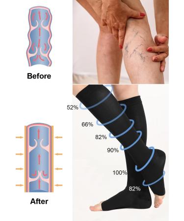 Buy 2 Pairs of Medical Compression Stockings for Men & Women | 20-30 mmHg Class 2 Open Lace - International Shipping - Buy Online on GoSupps.com