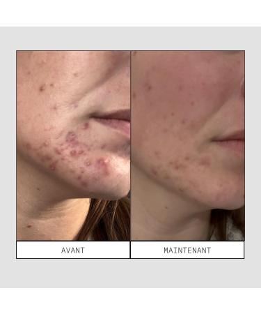 Skin & Out Lot Masque Exfoliant + Patchs Nez Anti-Pores Boutons & Points Noirs Exfoliation Chimique PHA & Acide Salicylique - Buy Online on GoSupps.com