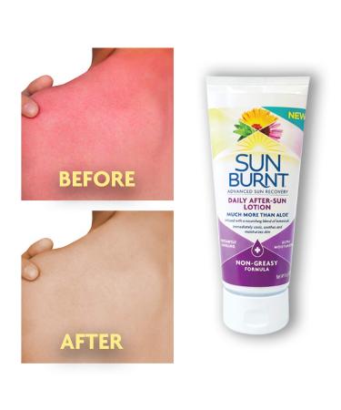 Sunburnt Advanced After-Sun Lotion 6oz - Soothing Relief for Sunburned Skin - Buy Online on GoSupps.com