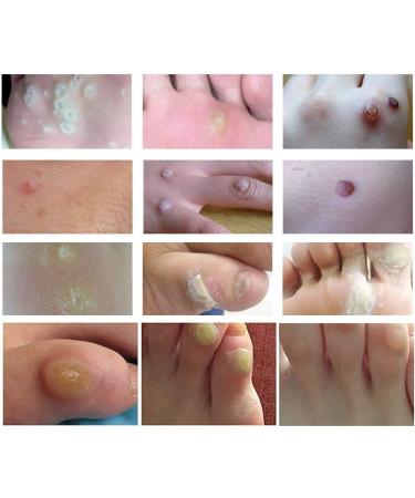 Wart Remover Corn Remover Foot Corn Remover Pads Plantar Wart Removal Corn Callus Remover Penetrates and Removes Common and Plantar Warts Callus Stops Wart Regrowth 20PC - Buy Online on GoSupps.com